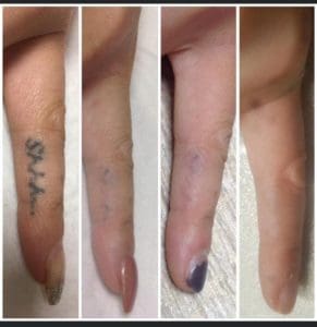 before and after image of a Tattoo on a finger after treatment using The Polaris RUBY 694 Q-Switched Laser