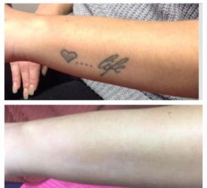 before and after image of an Arm Tattoo after treatment using The Polaris RUBY 694 Q-Switched Laser