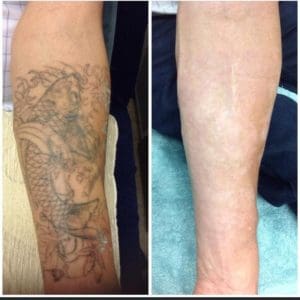 before and after image of an Arm Tattoo after treatment using The Polaris RUBY 694 Q-Switched Laser