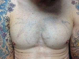 Photograph of large faded chest tattoo after tattoo removal using The Polaris RUBY 694 Q-Switched Laser